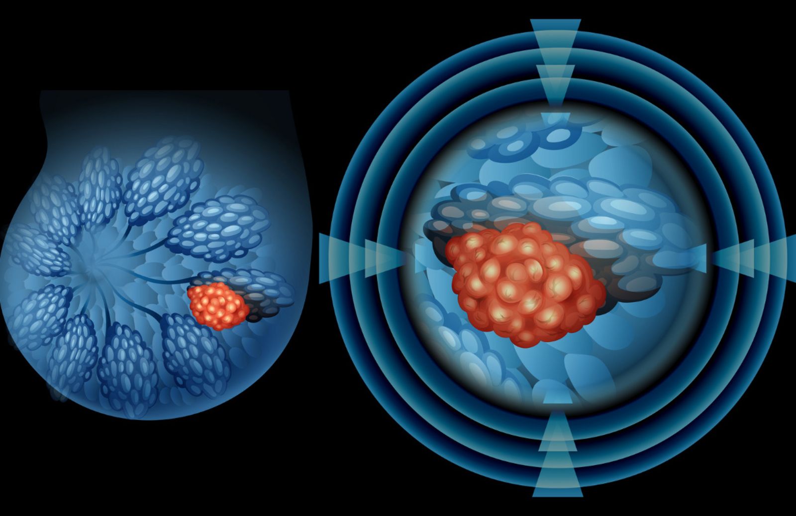 Come prevenire il tumore al seno con la mammografia