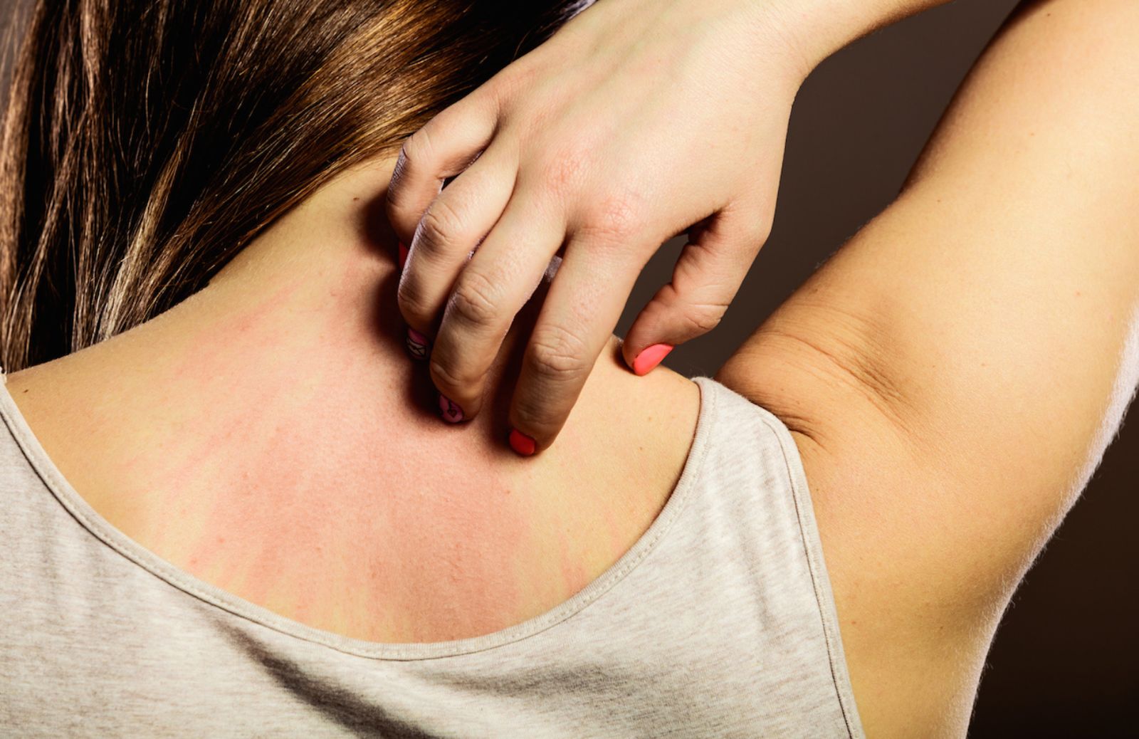 Come riconoscere i sintomi dell'orticaria